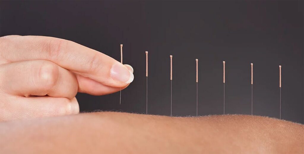 Acupuncture For Back Pain