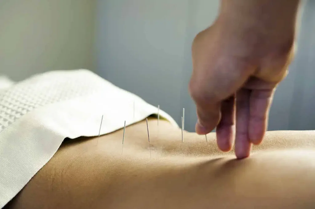 Acupuncture for Pain Relief