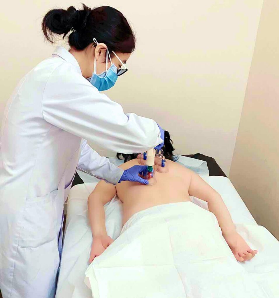 Cupping Treatment