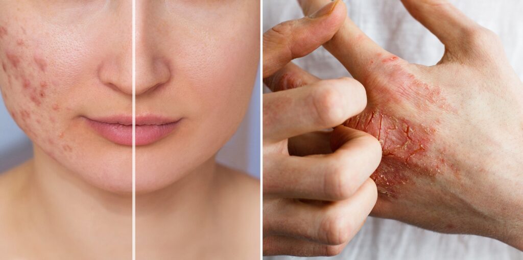 Acupuncture for skin conditions