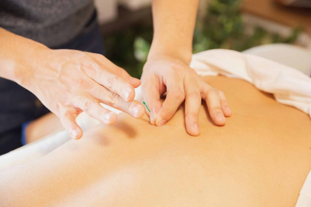 Top 10 Benefits of Acupuncture