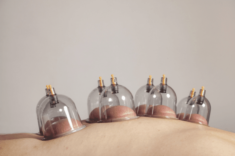 Does Cupping Therapy Work? What Research and Results Show
