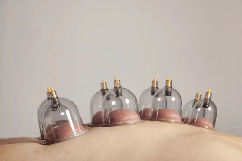 Does Cupping Therapy Work? What Research and Results Show