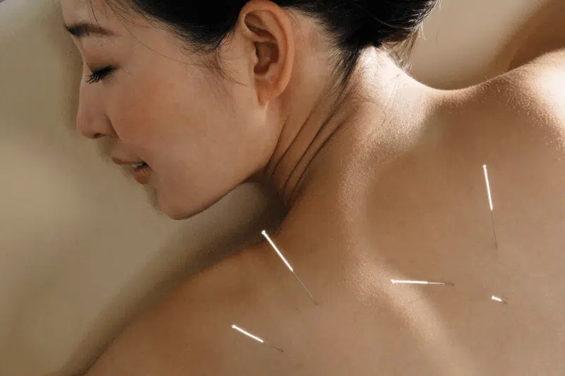 Acupuncture for Women: Natural Support for Stress, Sleep, and Hormonal Balance