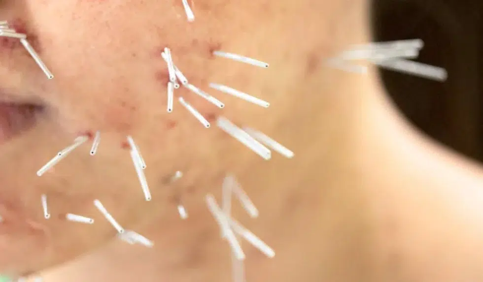 Acupuncture for Acne in Teenagers: Holistic Solution for Clearer Skin