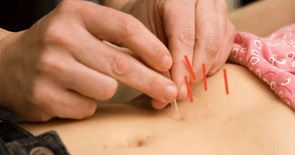 Acupuncture and Moxibustion for Irritable Bowel Syndrome (IBS): A Holistic Approach to Gut Health